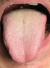 jazyk 003 s bielym povlakom a otlačkami zubov na pravej strane jazyka