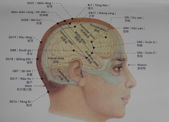 akupunktúra a hipertónia arcán)